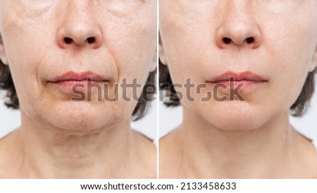 Lower part of face and neck of elderly woman with signs of skin aging before after facelift, plastic surgery on white background. Age-related changes, flabby sagging skin, wrinkles, creases, puffiness Stockfoto © 