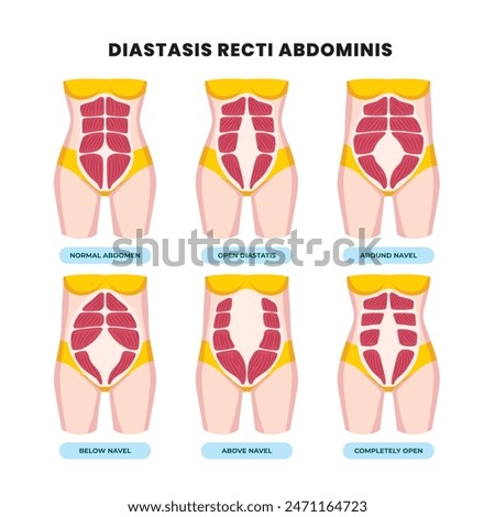 Types of diastasis recti poster scheme, medical education banner, abdominal separation, pregnant women. Abdomen muscles, anatomy, postpartum care, six pack separation belly rectus Linea alba abdominal