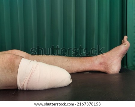Below knee amputation bandaging for BK prosthesis.
 Imagine de stoc © 