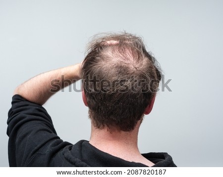 Back of a young balding man's head showing clear signs of balding and hair loss around the scalp. Male pattern baldness concept against a clear white background with room for text. 商業照片 © 
