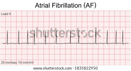 Electrocardiogram show Atrial fibrillation (AF) pattern. Cardiac fibrillation. Heart beat. CPR. ECG. EKG. Vital sign. Life support. Defib. Emergency. Medical healthcare symbol.