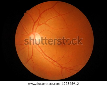 retina and optic nerve normal (Left)