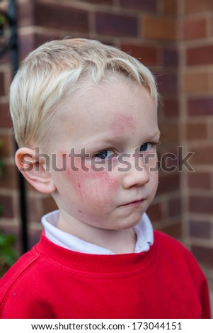 schoolboy with graze injury on face after slipping over