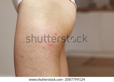 Similar – Image, Stock Photo skin allergies, hips skin women. Closeup of red pustules on a hips, an allergic reaction caused by atopic dermatitis. Selected focus