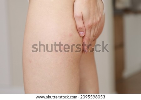 Similar – Image, Stock Photo skin allergies, hips skin women. Closeup of red pustules on a hips, an allergic reaction caused by atopic dermatitis. Selected focus