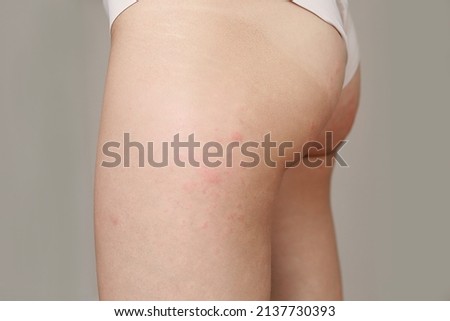 Similar – Image, Stock Photo skin allergies, hips skin women. Closeup of red pustules on a hips, an allergic reaction caused by atopic dermatitis. Selected focus