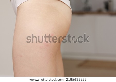Similar – Image, Stock Photo skin allergies, hips skin women. Closeup of red pustules on a hips, an allergic reaction caused by atopic dermatitis. Selected focus