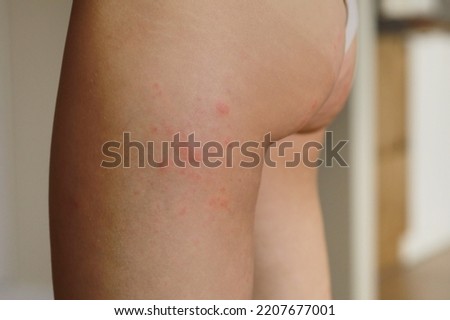 Similar – Image, Stock Photo skin allergies, hips skin women. Closeup of red pustules on a hips, an allergic reaction caused by atopic dermatitis. Selected focus