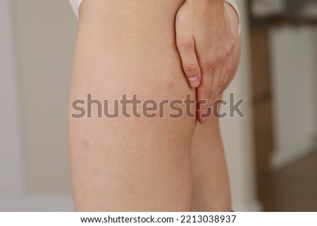 Image, Stock Photo skin allergies, hips skin women. Closeup of red pustules on a hips, an allergic reaction caused by atopic dermatitis. Selected focus