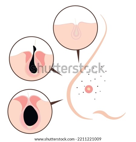 Black Dots on Nose. Clogged Pores.  Close up view of Blackhead.  black ace young face, problem comedones. Vector stock illustration. Isolated on a white background