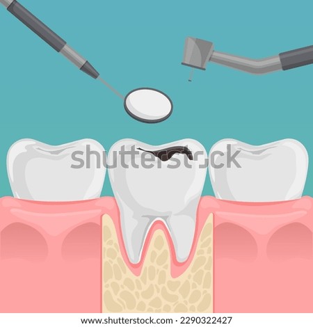 Teeth with decay in gum. Tooth with caries hole treatment concept. Dentist's tools. Flat cartoon dentistry vector illustration. Stock foto © 