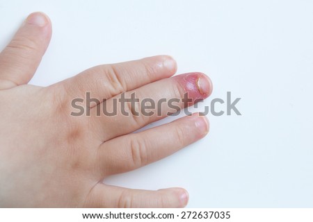 Paronychia, Swollen Finger With Fingernail Bed Inflammation Due To ...