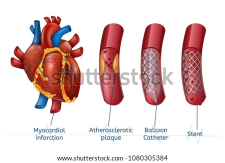 Myocardial infarction. 3d Realostic Stent in Illustration of Human Heart with Blocked Coronary Artery. Vector Plaque Heart Attack. Angioplasty.