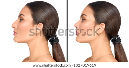 Before and after plastic surgery of nose. Rhinoplasty. Crooked nose correcting. Young woman profile portrait, isolated on white background. Beauty female, model girl face close-up. Aesthetic medicine