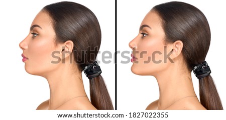 Before and after plastic surgery of a chin. Cosmetic correction small weak chin, plastic surgery, reduction surgery, implants, fillers. Aesthetic medicine. Beautiful Young woman portrait