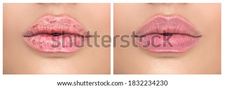 Lips. Close up of chapped, cracked lips, dry skin problem with mouth disease before and after treatment. Healthy woman lips, macro shot. 