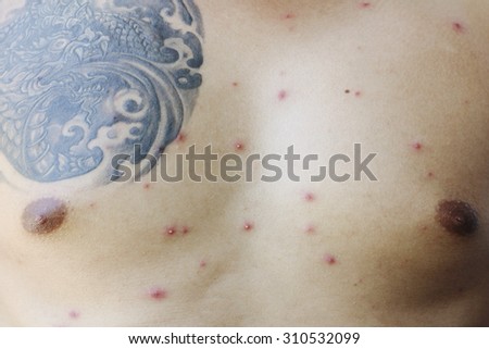 Chickenpox rash on chest of a man with tattoos.