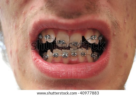 Close up of mouth. crooked teeth with braces