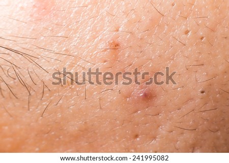 Closed-up of pimple blackheads on the forehead of an Asian teenager