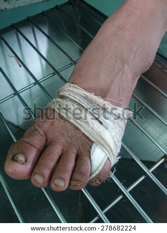 Gauze bandage the foot,treating patients with foot ulcers