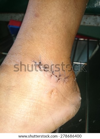 Stitches in the leg (ankle)