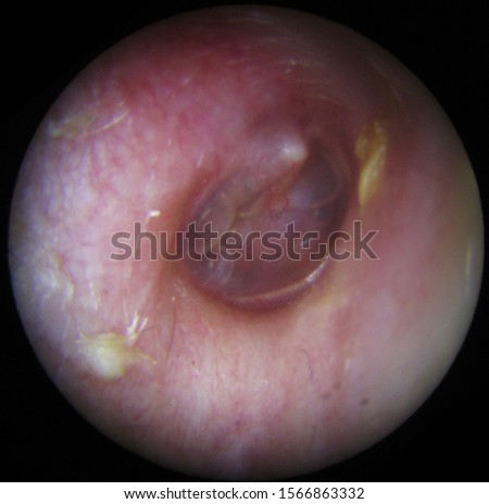 otitis media with effusion, right ear Stock fotó © 