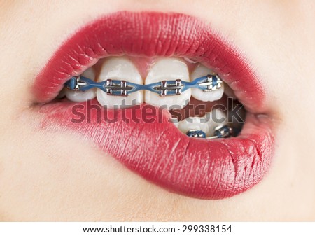 Girl with braces bitting lip