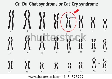 Cri du chat syndrome , also known as 5p- (5p minus) syndrome or cat cry syndrome,  deletion of genetic material on the small arm (the p arm) of chromosome5.Genetic syndromes mentioned 