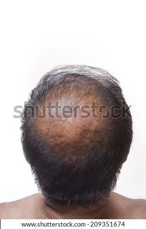 Human alopecia or hair loss, adult man bald head back view