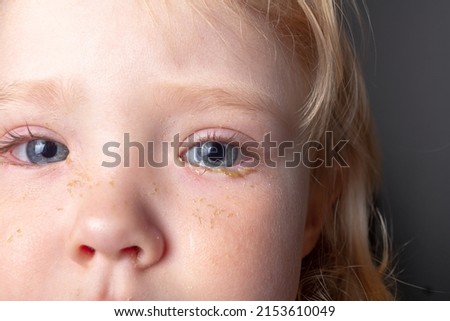 Conjunctivitis in the eyes of a child, pus and inflammation of the eyes of a baby girl close-up Imagine de stoc © 