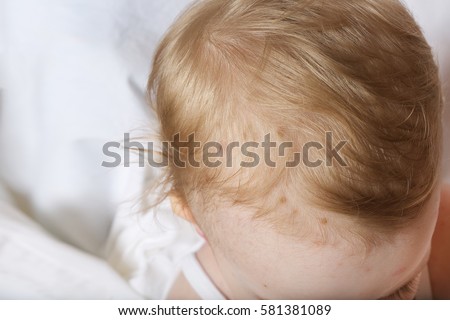 Chicken Pox On Scalp Free Images And Photos Avopixcom