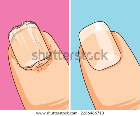 Care of natural nails. File the nail. Broken nail. Before, after. Healthcare illustration. Vector illustration.