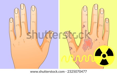 Effects of radiation on human health. Skin lesion. Healthcare illustration, medical illustration. Vector illustration. 