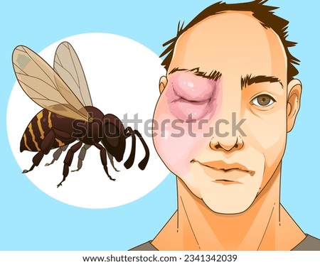 Bee sting. Swollen face. Swollen eye. Injury after a bee sting.  Redness on the skin. Closeup illustration. Healthcare illustration, vector illustration. 