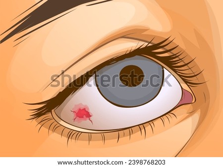 A capillary in the eye burst. Inflammation of the cornea. Close-up illustration of the human eye. Healthcare illustration. Vector illustration. 