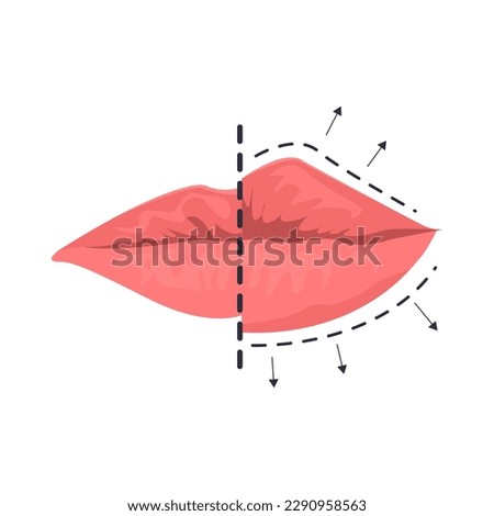 Lip augmentation illustration in color cartoon style. Editable vector graphic design.