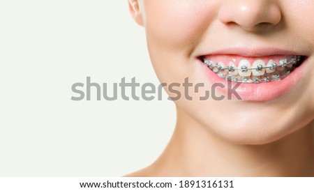 Orthodontic Treatment. Dental Care Concept. Beautiful Woman Healthy Smile close up. Closeup Ceramic and Metal Brackets on Teeth. Beautiful Female Smile with Braces Stock foto © 