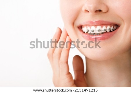 Smile with Braces Orthodontic Treatment. Dental Care Concept. Beautiful Woman Healthy Smile close up. Closeup Ceramic and Metal Brackets on Teeth. Beautiful Female Stock foto © 