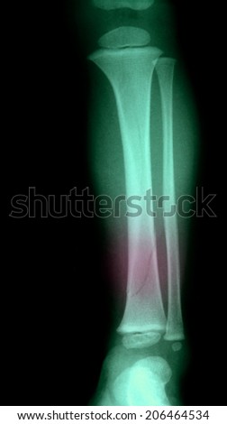 leg fracture with displacement