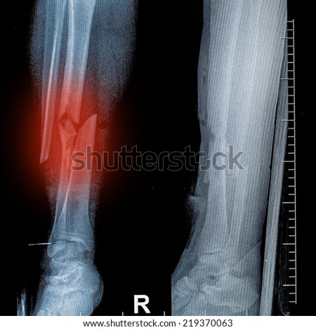X ray film of bone leg fracture.