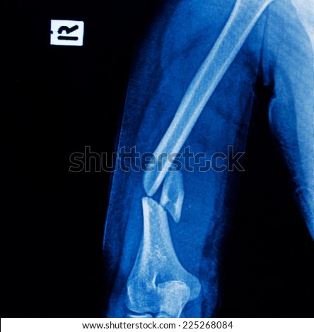 x-ray image of broken arm bone show pre-post operation (Anatomy of fracture humerus )