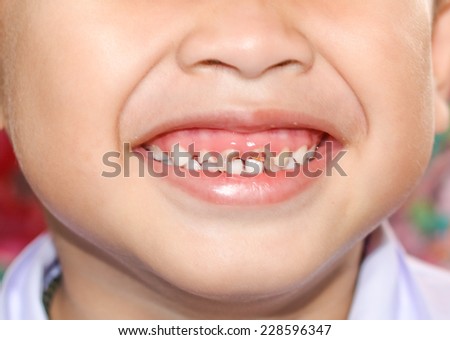 kid patient open mouth showing cavities teeth decay