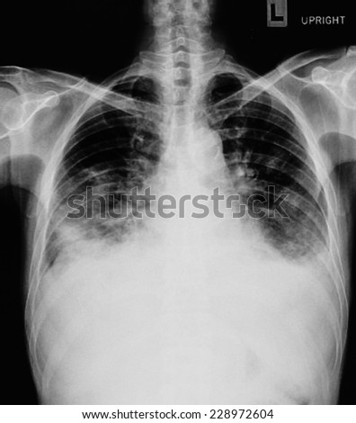 pneumonia test scanning, modern x-rays radiography details