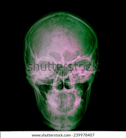 film x-ray skull AP : show normal asian human's skull