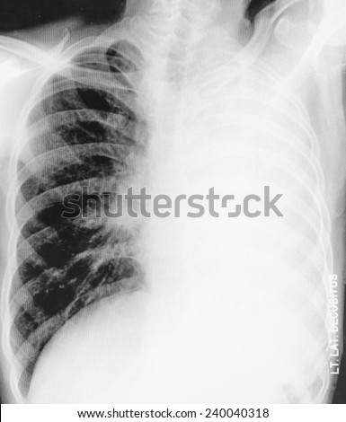 chest X-ray show pulmonary disease