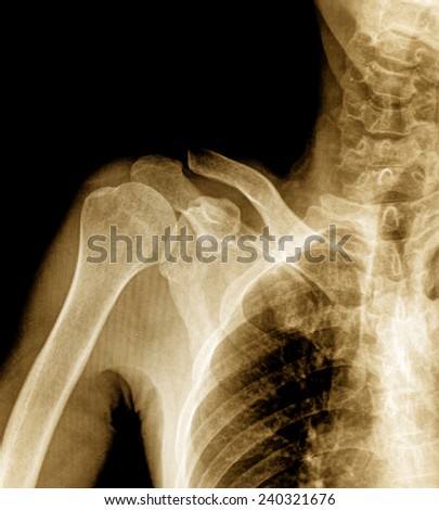 X-ray of shoulder joint / Many others X-ray images in my portfolio.