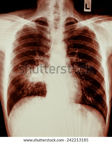 X-ray of human cancer lungs