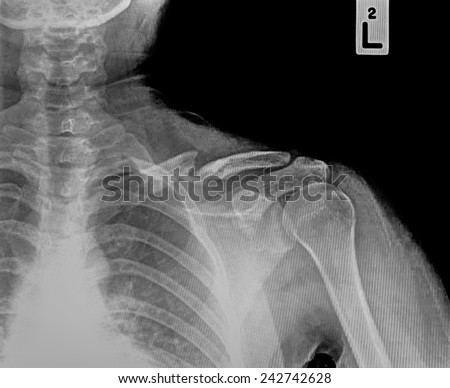 Film X-ray show fracture clavicle