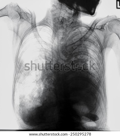Chest film demonstrated tuberculosis (TB) at left upper lung.