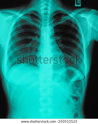 X-Ray Image Of Chest for a medical diagnosis